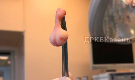 Врачи ДРКБ Татарстана удалили маленькому пациенту лишний язык